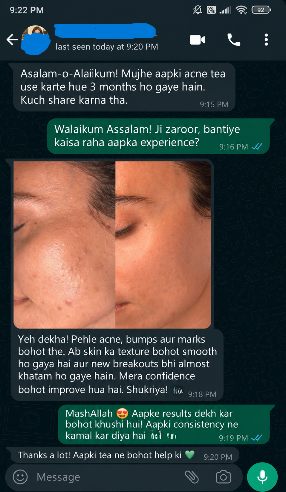 Acne tea feedack